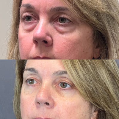 Lower Blepharoplasty Before & After Gallery - Patient 323680 - Image 2