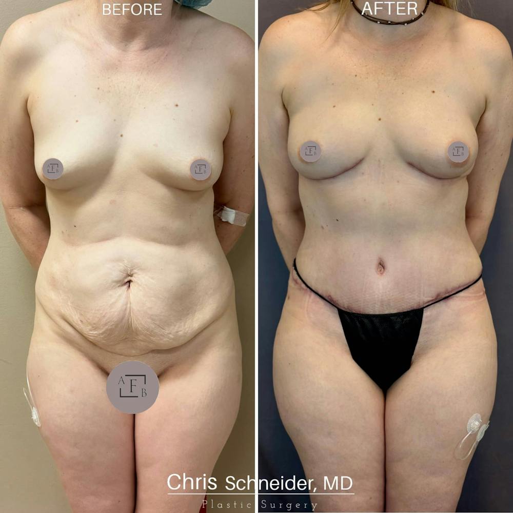 Breast Reconstruction  Before & After Gallery - Patient 165335 - Image 1