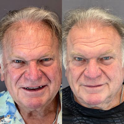 Hair Restoration  Before & After Gallery - Patient 403593 - Image 1