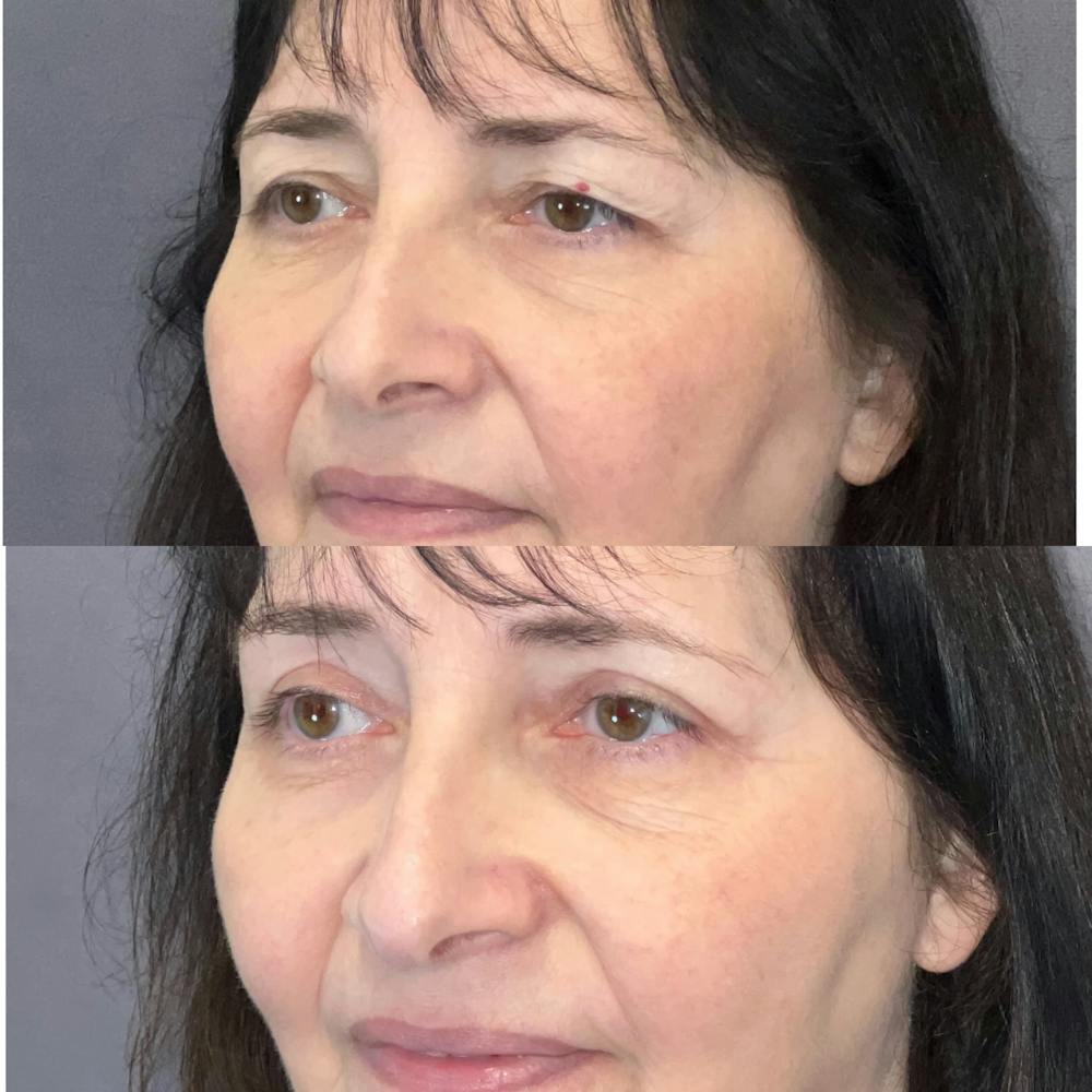 Upper Blepharoplasty Before & After Gallery - Patient 247676 - Image 3