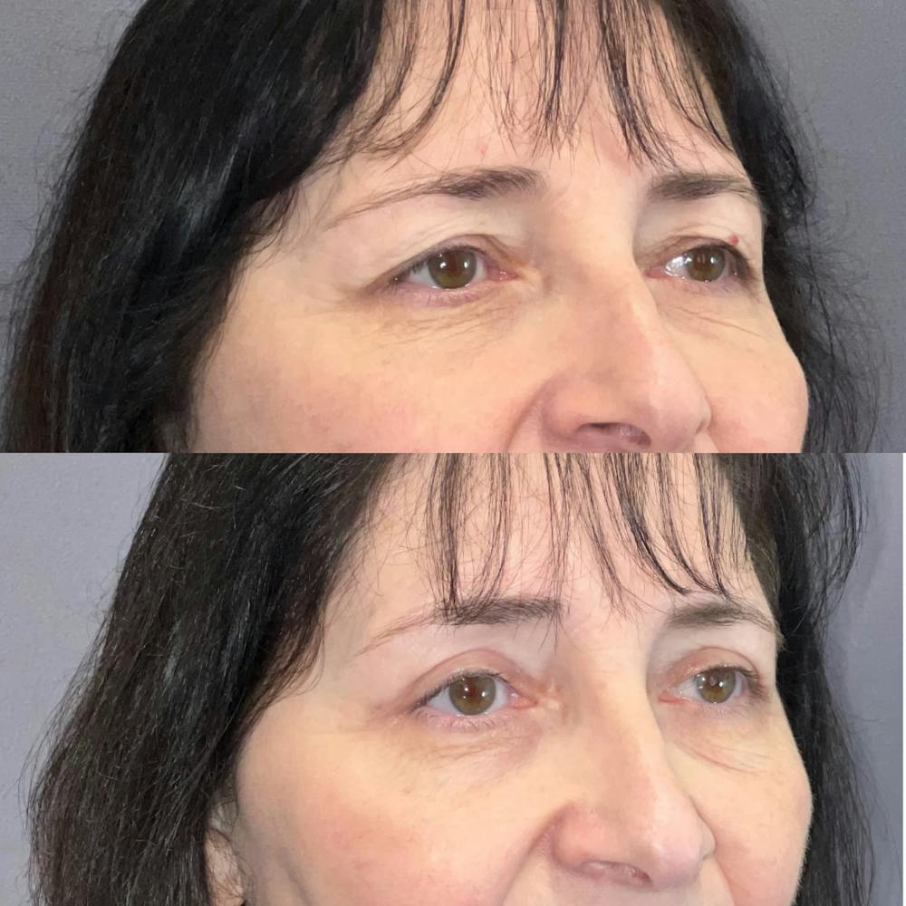 Upper Blepharoplasty Before & After Gallery - Patient 247676 - Image 2