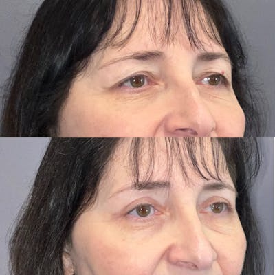 Upper Blepharoplasty Before & After Gallery - Patient 247676 - Image 2