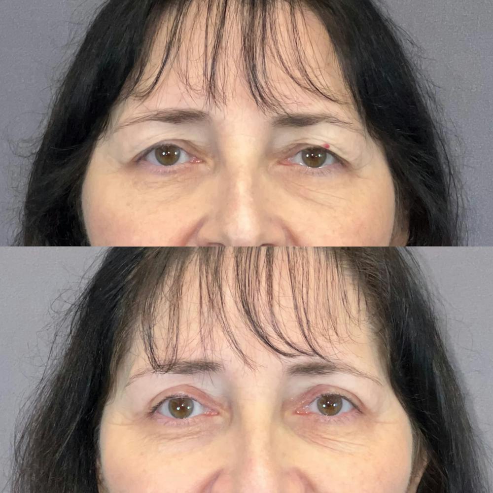 Upper Blepharoplasty Before & After Gallery - Patient 247676 - Image 1
