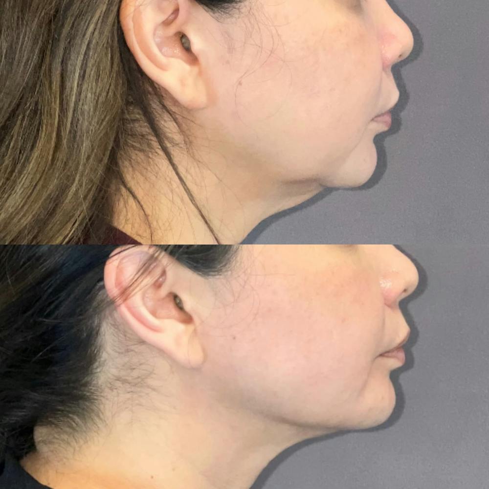 Facetite Before & After Gallery - Patient 178263 - Image 1