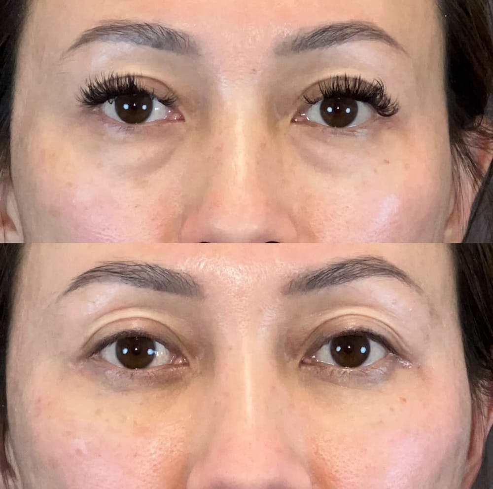 Lower Blepharoplasty Before & After Gallery - Patient 312064 - Image 1