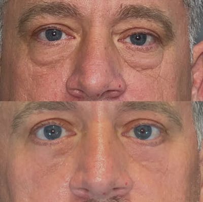 Lower Blepharoplasty Before & After Gallery - Patient 947376 - Image 1