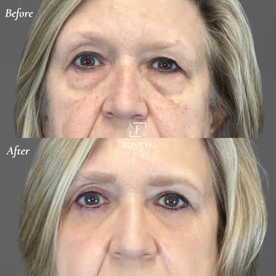 BBL Hero Before & After Gallery - Patient 121911 - Image 1