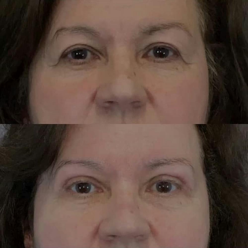 Upper Blepharoplasty Before & After Gallery - Patient 141033 - Image 1