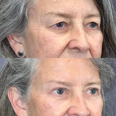Upper Blepharoplasty Before & After Gallery - Patient 385556 - Image 1
