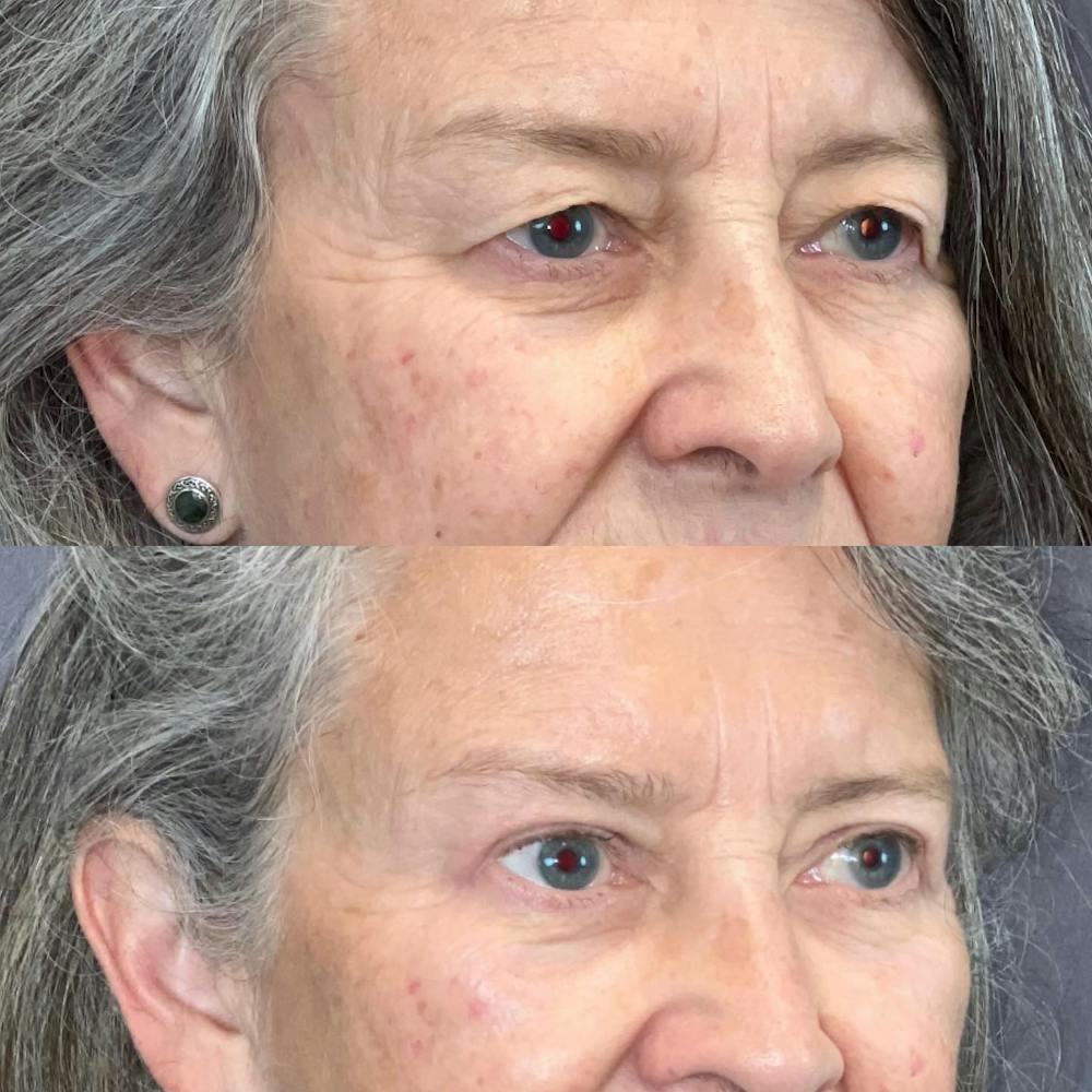 Upper Blepharoplasty Before & After Gallery - Patient 385556 - Image 1