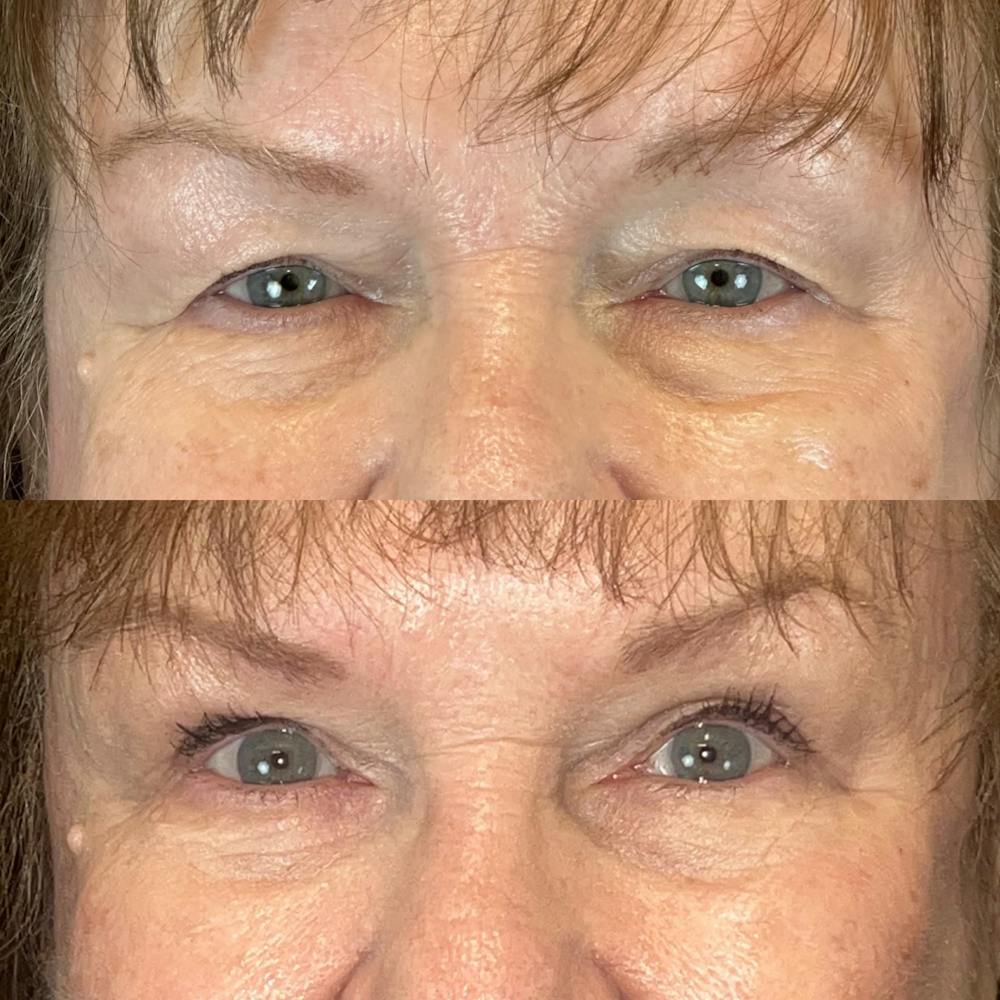 Upper Blepharoplasty Before & After Gallery - Patient 136527 - Image 1