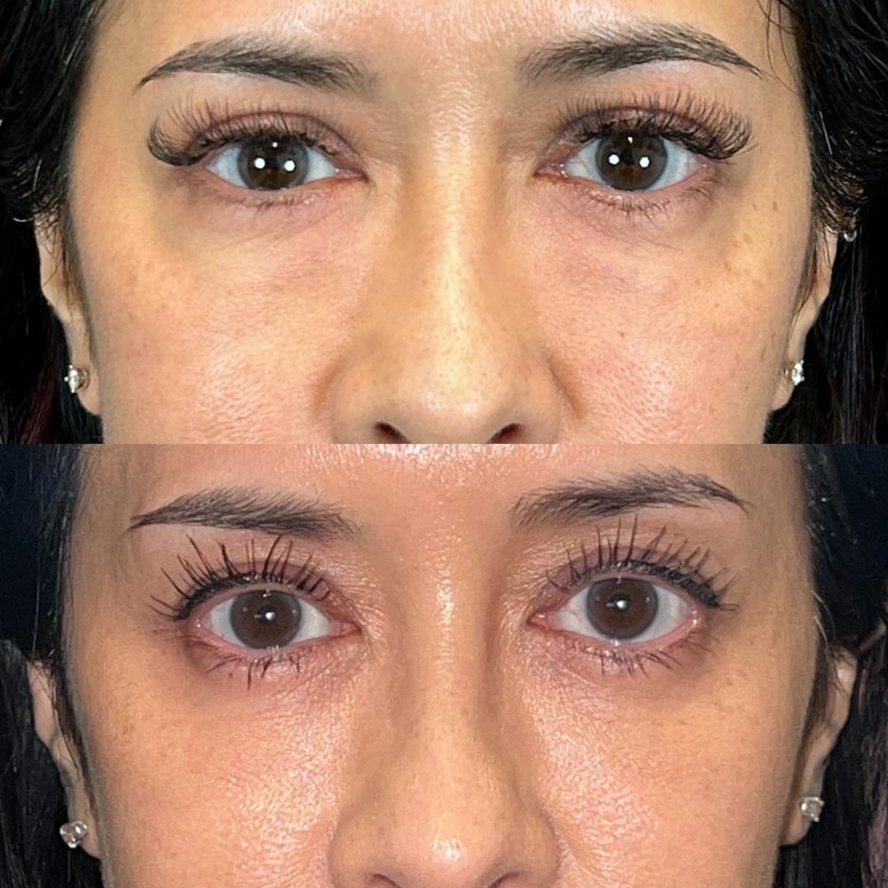 Lower Blepharoplasty Before & After Gallery - Patient 971140 - Image 1
