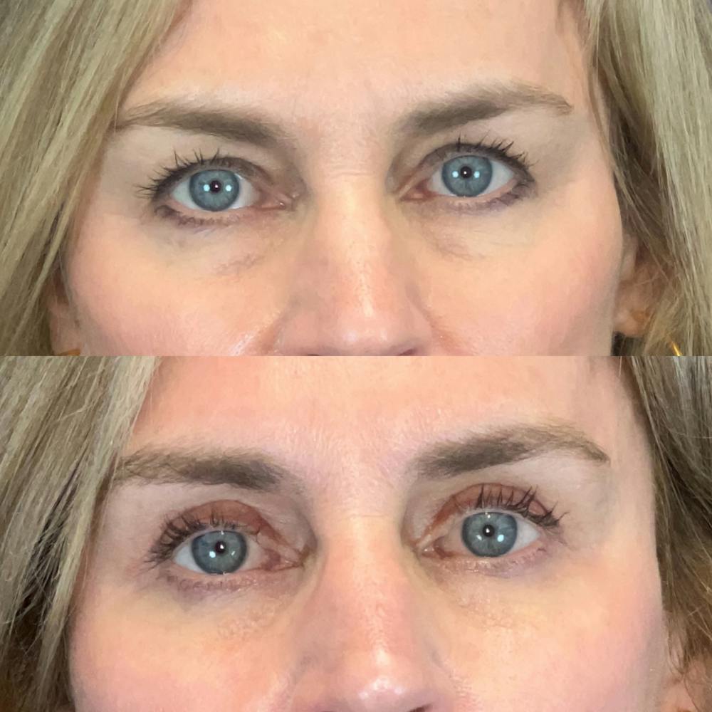 Patient Lower Blepharoplasty Before & After Photos Patient Lower Blepharoplasty Before & After Photos