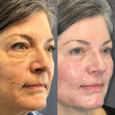 Laser Resurfacing Before & After Gallery - Patient 832400 - Image 2