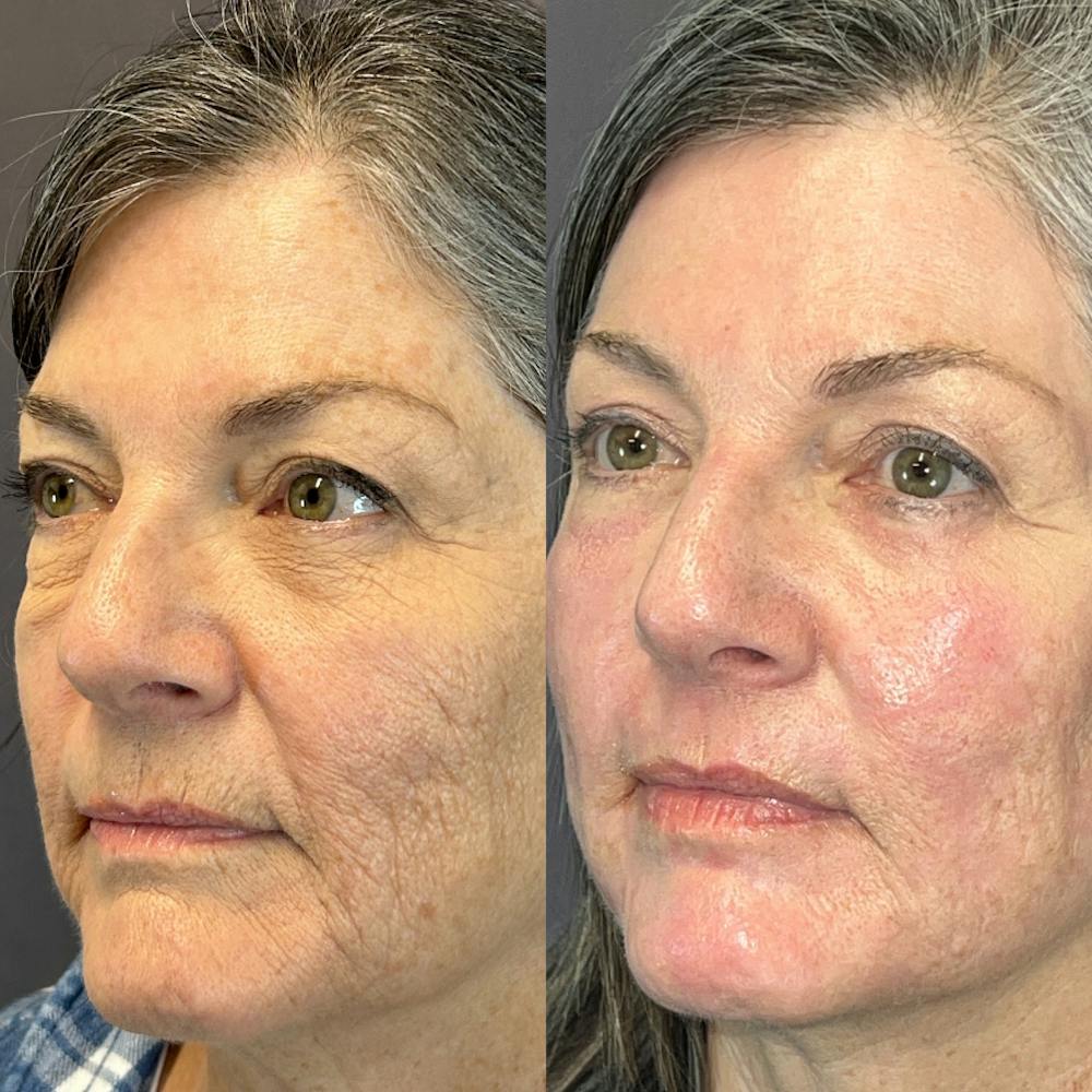 Laser Resurfacing Before & After Gallery - Patient 832400 - Image 3
