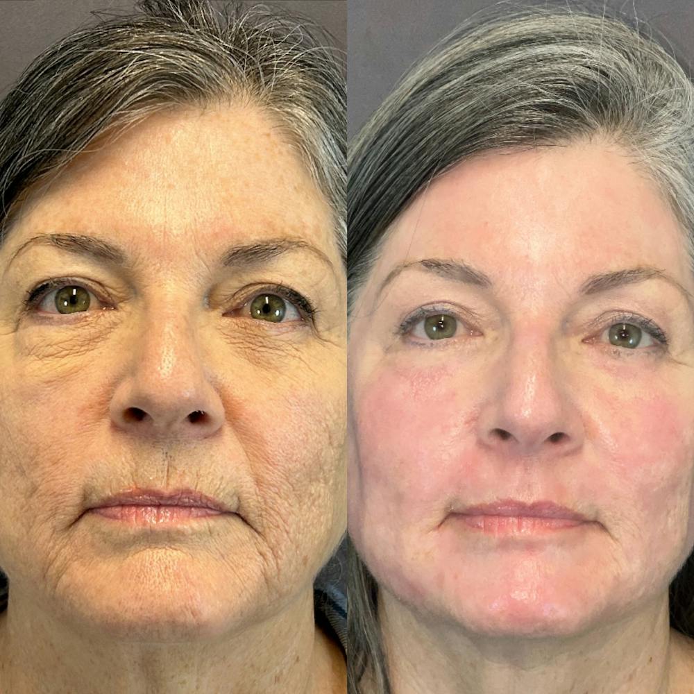 Laser Resurfacing Before & After Gallery - Patient 832400 - Image 1