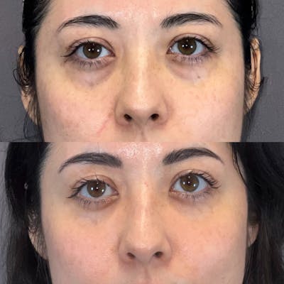Lower Blepharoplasty Before & After Gallery - Patient 354135 - Image 1