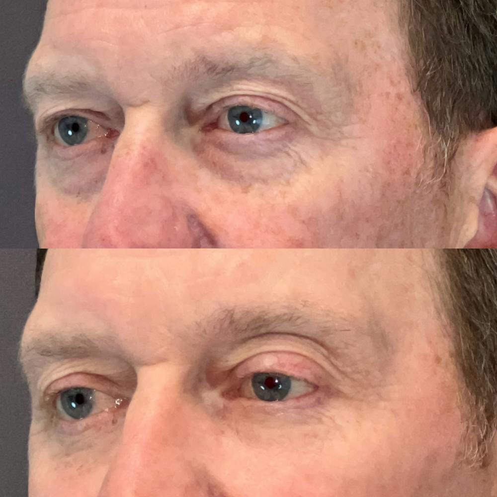 Laser Resurfacing Before & After Gallery - Patient 164144 - Image 3