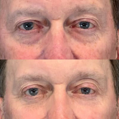 Laser Resurfacing Before & After Gallery - Patient 164144 - Image 1