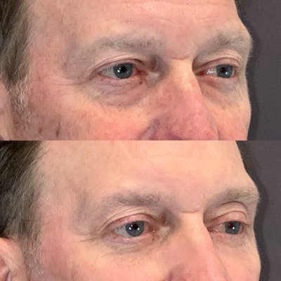 Lower Blepharoplasty Before & After Gallery - Patient 261138 - Image 2