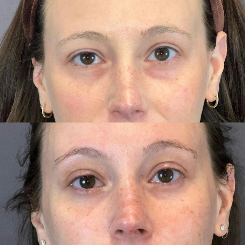 Lower Blepharoplasty Before & After Gallery - Patient 338876 - Image 1