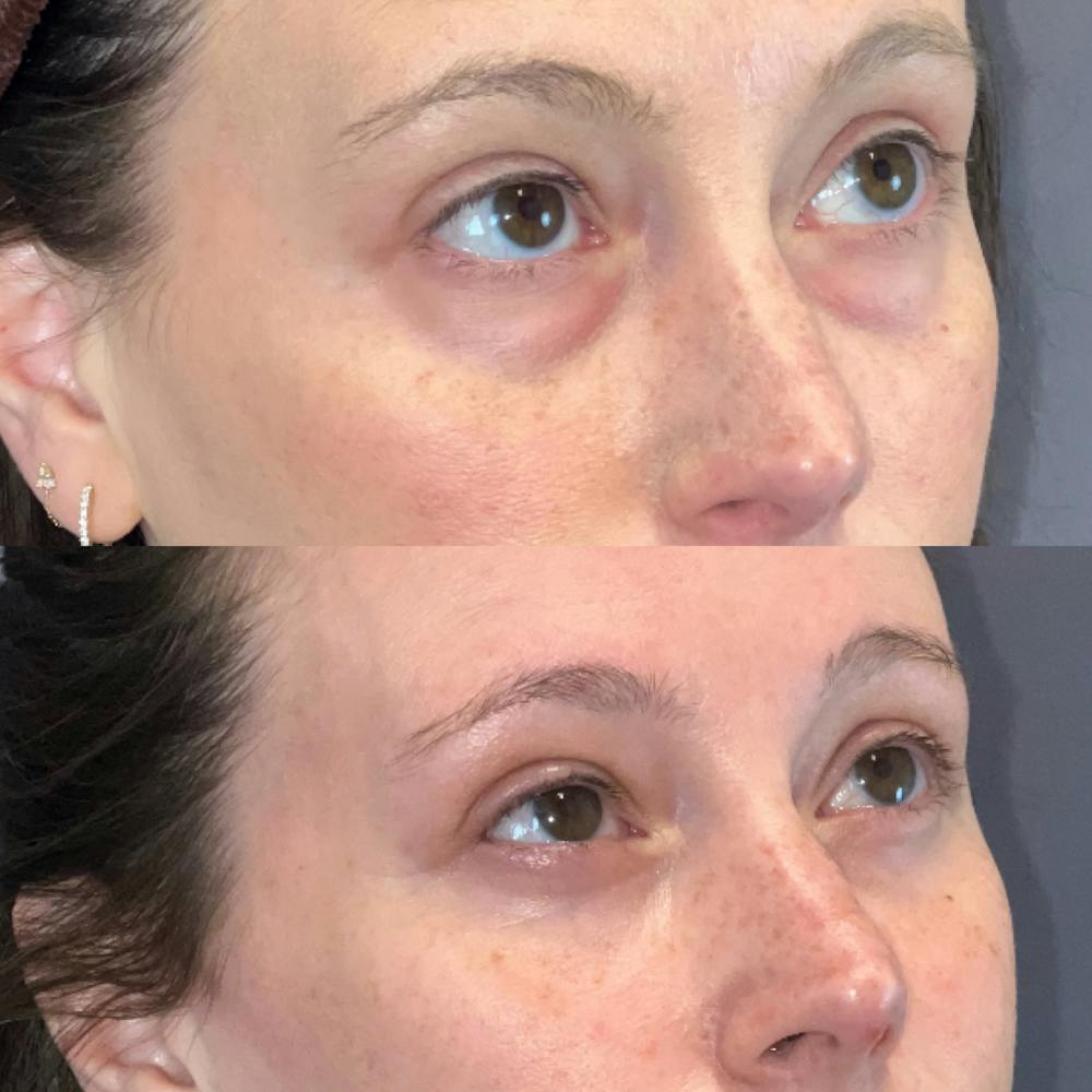 Lower Blepharoplasty Before & After Gallery - Patient 338876 - Image 3