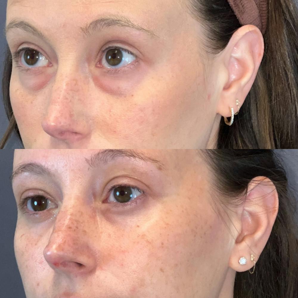 Lower Blepharoplasty Before & After Gallery - Patient 338876 - Image 4