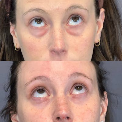 Lower Blepharoplasty Before & After Gallery - Patient 338876 - Image 2