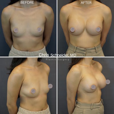 Breast Augmentation Before & After Gallery - Patient 387979 - Image 1