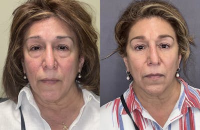 Lower Blepharoplasty Before & After Gallery - Patient 102545 - Image 1
