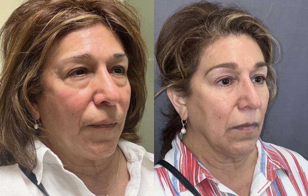 Lower Blepharoplasty Before & After Gallery - Patient 102545 - Image 2