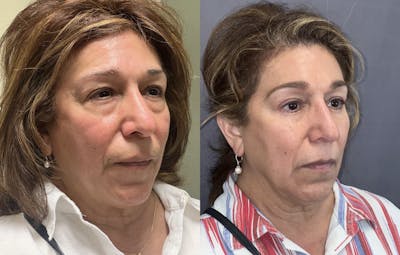 Lower Blepharoplasty Before & After Gallery - Patient 102545 - Image 2