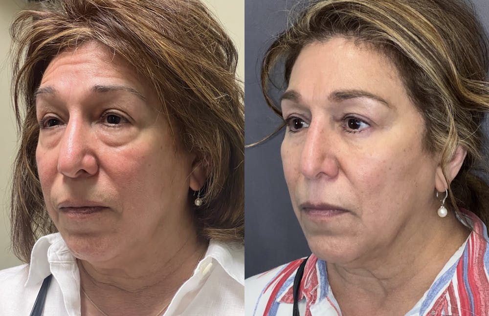 Lower Blepharoplasty Before & After Gallery - Patient 102545 - Image 3