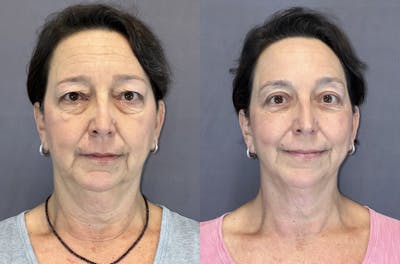 Upper Blepharoplasty Before & After Gallery - Patient 399713 - Image 1