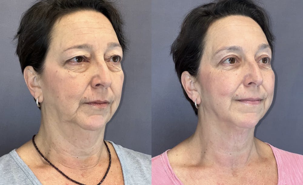 Upper Blepharoplasty Before & After Gallery - Patient 399713 - Image 2