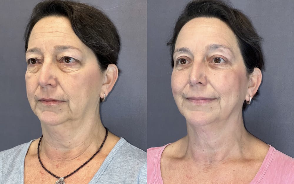 Upper Blepharoplasty Before & After Gallery - Patient 399713 - Image 3