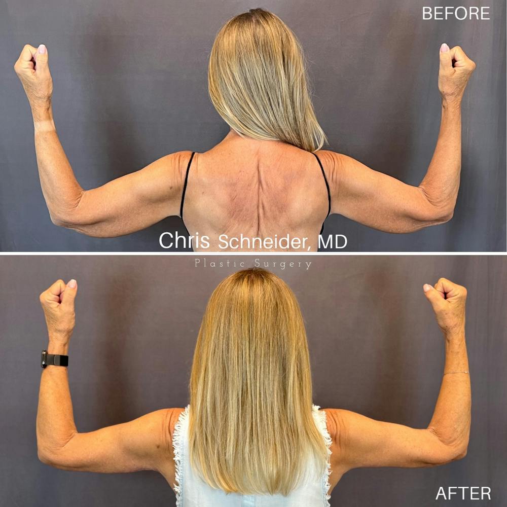Arm Lift Before & After Gallery - Patient 369960 - Image 1