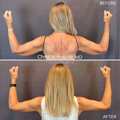 Arm Lift Before & After Gallery - Patient 369960 - Image 1