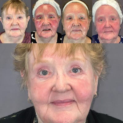 Laser Resurfacing Before & After Gallery - Patient 374606 - Image 1