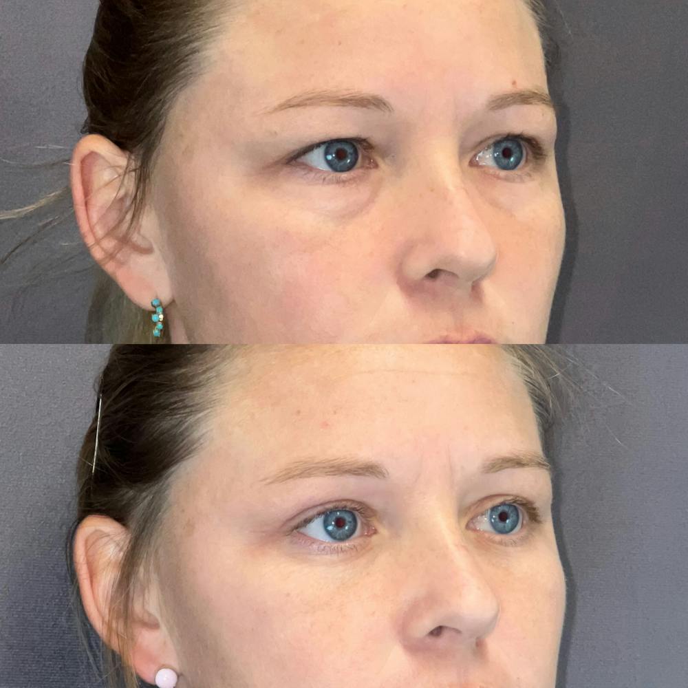 Upper Blepharoplasty Before & After Gallery - Patient 135314 - Image 2
