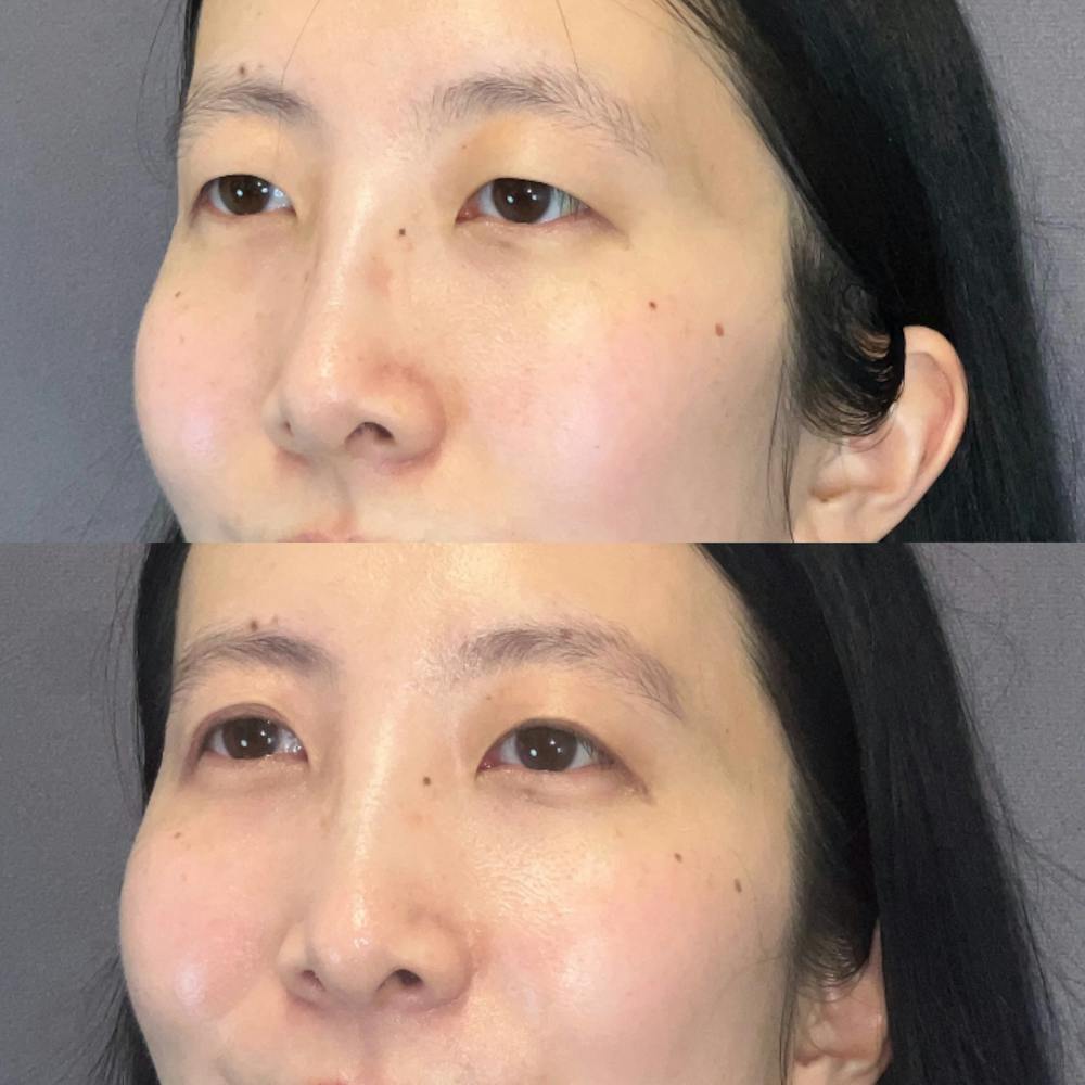 Asian Blepharoplasty Before & After Gallery - Patient 991187 - Image 3