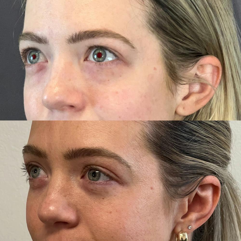 Lower Blepharoplasty Before & After Gallery - Patient 172153 - Image 3