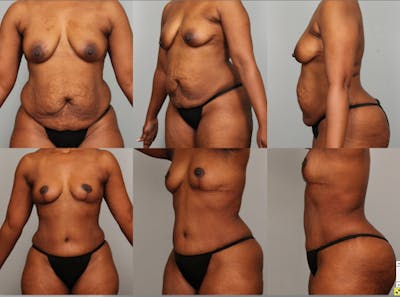 Tummy Tuck (Abdominoplasty) Before & After Gallery - Patient 868698 - Image 1