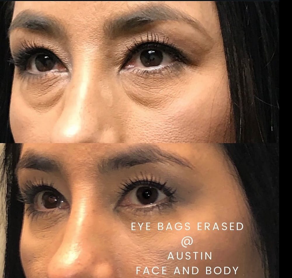 Lower Blepharoplasty Before & After Gallery - Patient 169736 - Image 1