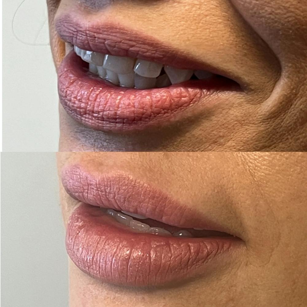 Lip Fillers Before & After Gallery - Patient 235564 - Image 1