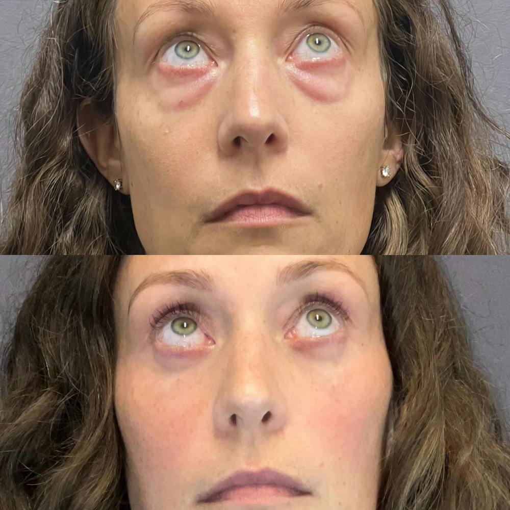 Upper Blepharoplasty Before & After Gallery - Patient 345550 - Image 2