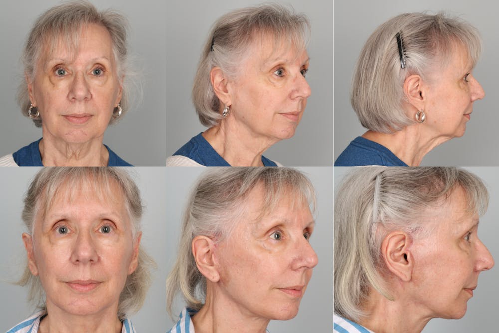 Facelift Before & After Gallery - Patient 419935 - Image 1