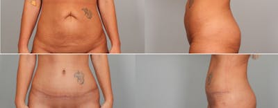 Tummy Tuck (Abdominoplasty) Before & After Gallery - Patient 634352 - Image 1