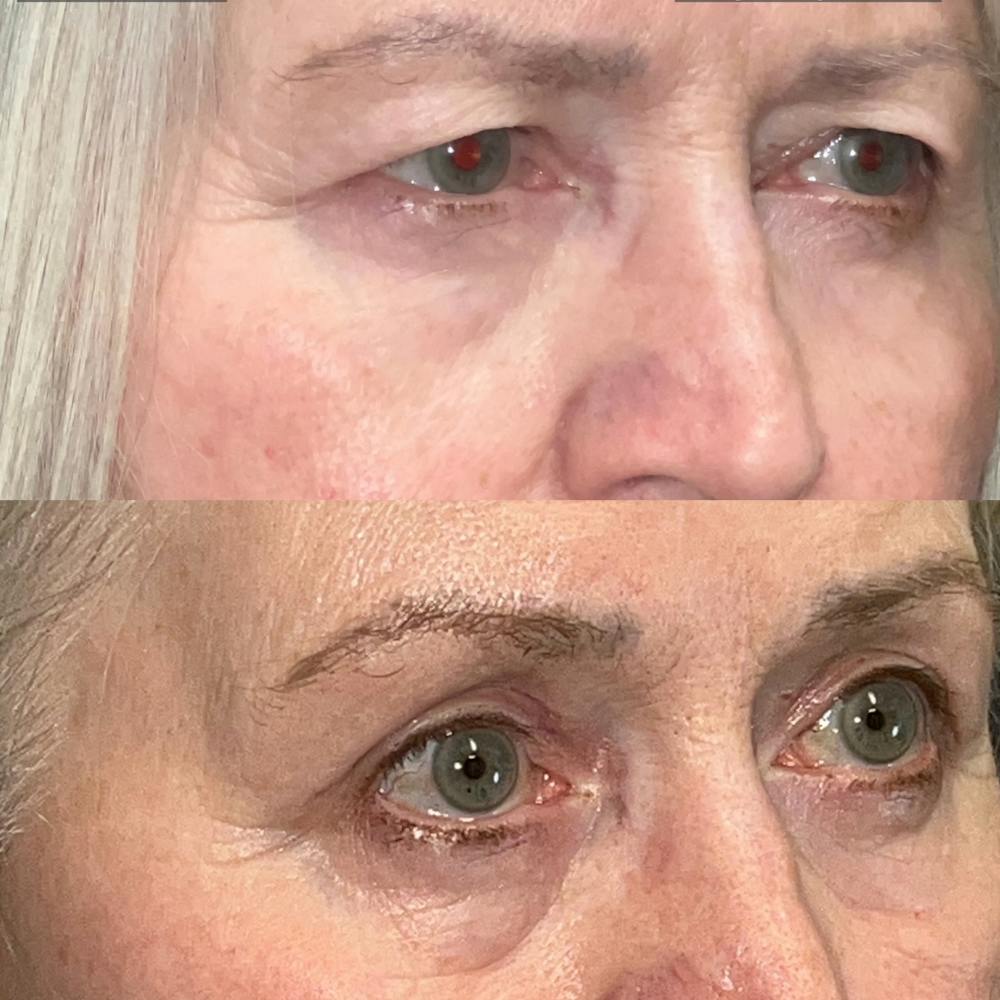 Upper Blepharoplasty Before & After Gallery - Patient 188840 - Image 2