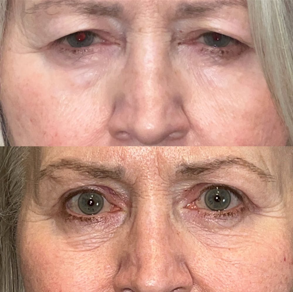 Upper Blepharoplasty Before & After Gallery - Patient 188840 - Image 1